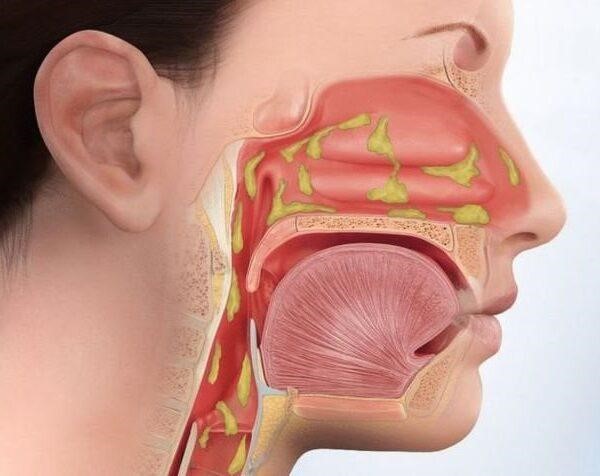 Persistent Nasal Discharge